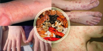 Dị ứng hải sản : Điều trị và phòng ngừa nhanh chóng tại nhà